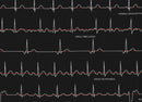 Surgical Cap EKG